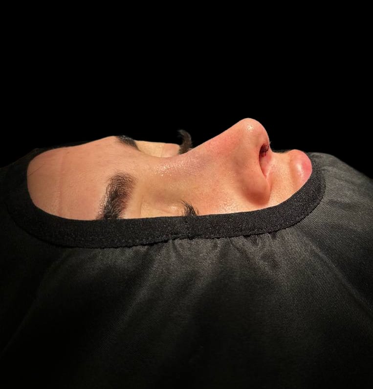 rinoplastia-caracas