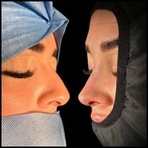rinoplastia-caracas
