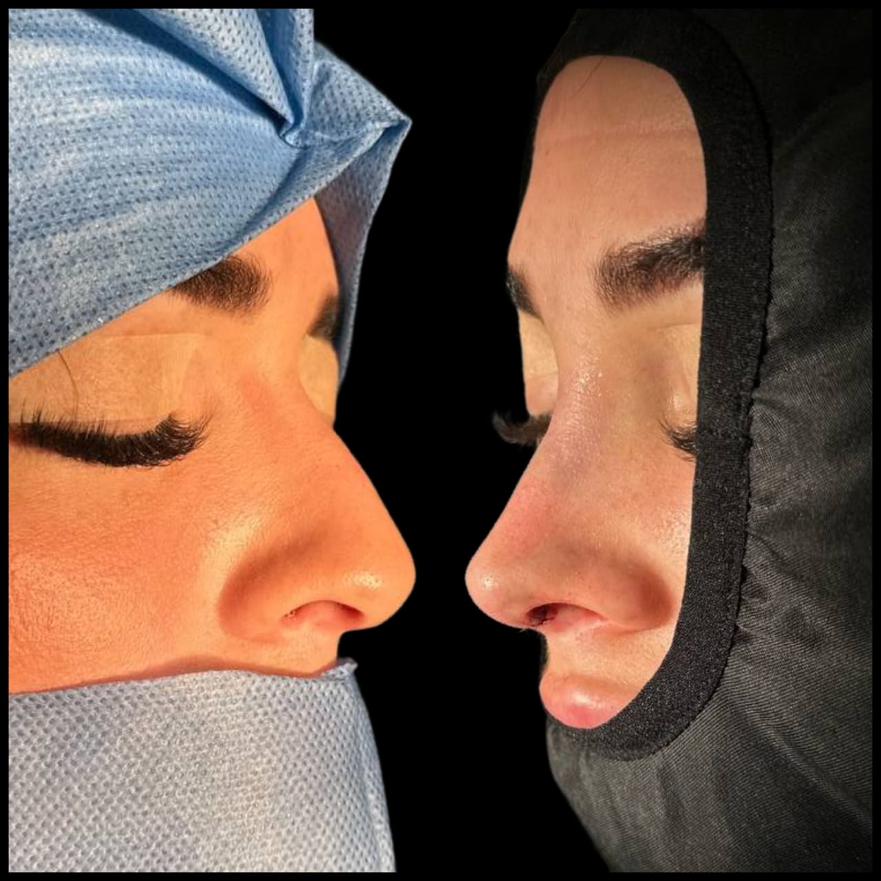 rinoplastia-caracas