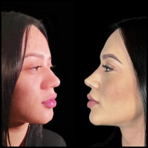 rinoplastia-caracas