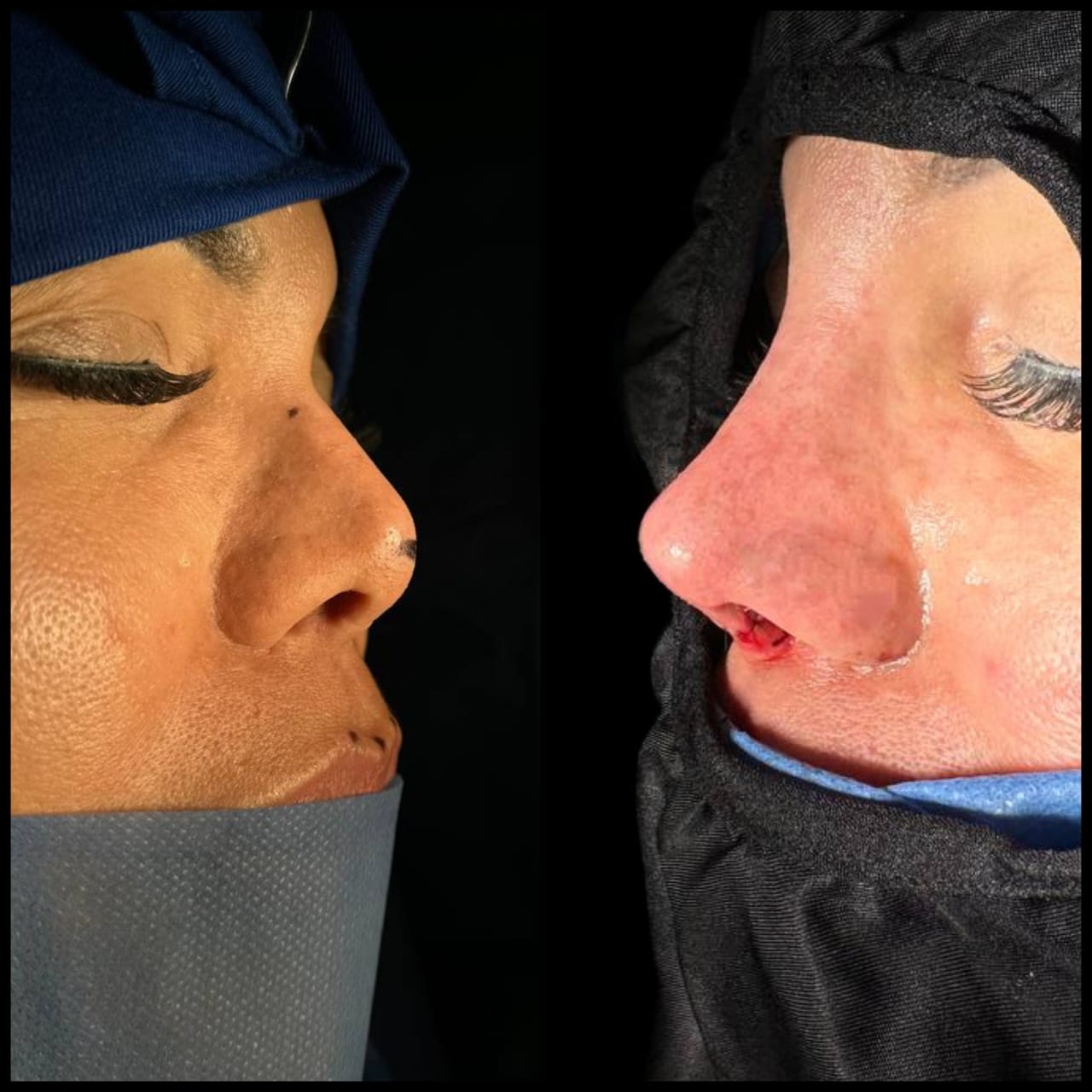 rinoplastia-caracas
