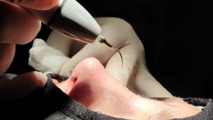rinoplastia ultrasonica