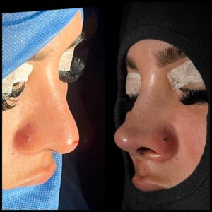 rinoplastia-caracas