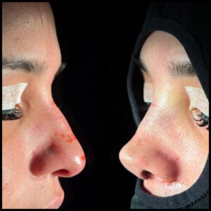rinoplastia-caracas