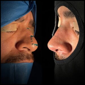 rinoplastia-caracas