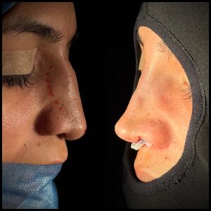rinoplastia-caracas