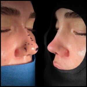 rinoplastia-caracas