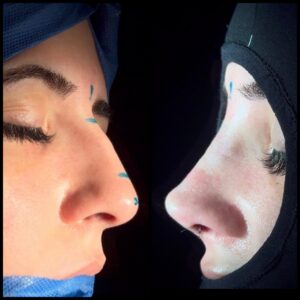 rinoplastia-caracas