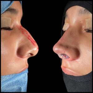 rinoplastia-caracas