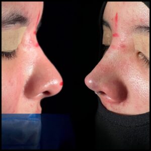 rinoplastia-caracas